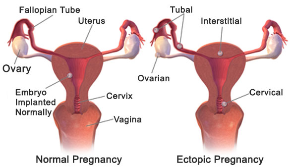 Ectopic Pregnancy
