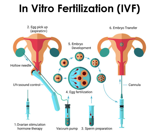 In Vitro Fertilisation