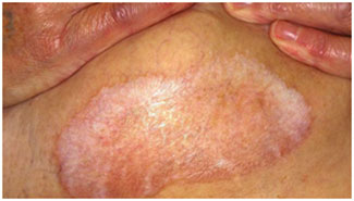 Lichen Sclerosus