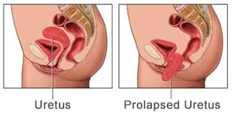 Uterine Prolapse
