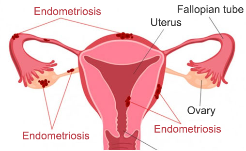 Endometriosis