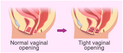 Vaginismus